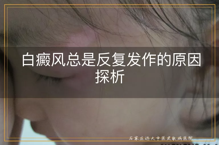 白癜风总是反复发作的原因探析