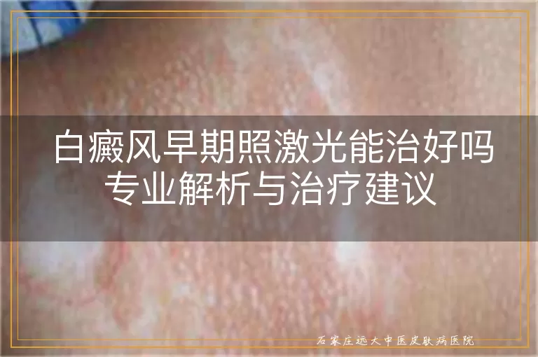 白癜风早期照激光能治好吗专业解析与治疗建议