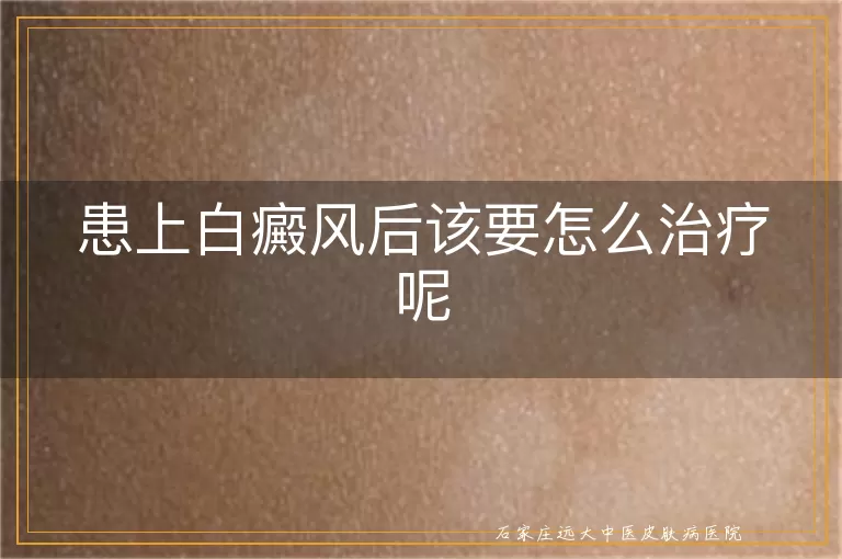 患上白癜风后该要怎么治疗呢