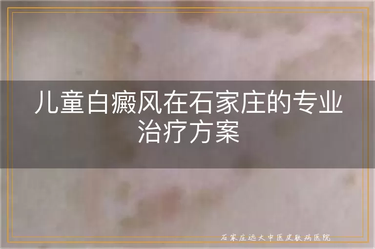 儿童白癜风在石家庄的专业治疗方案