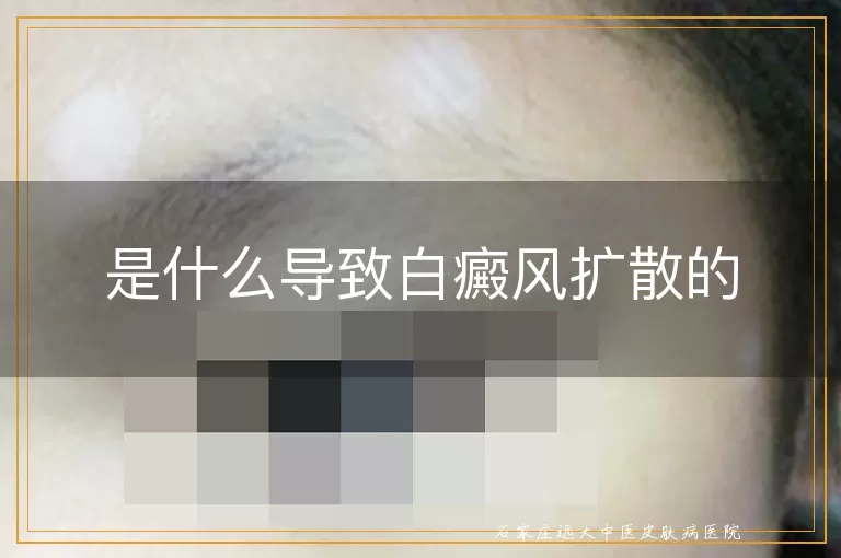 是什么导致白癜风扩散的