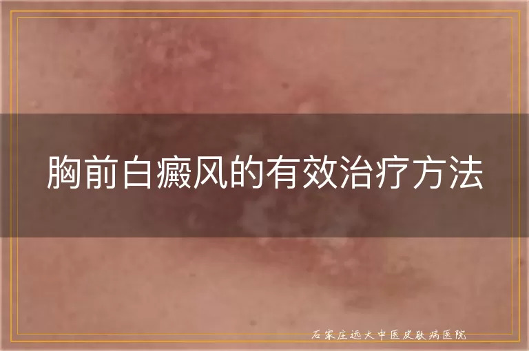 胸前白癜风的有效治疗方法