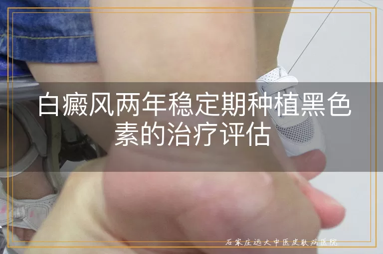 白癜风两年稳定期种植黑色素的治疗评估