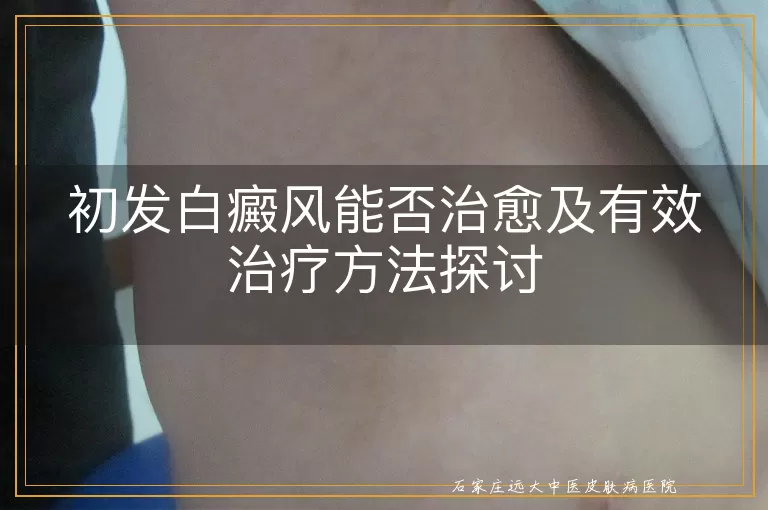 初发白癜风能否治愈及有效治疗方法探讨