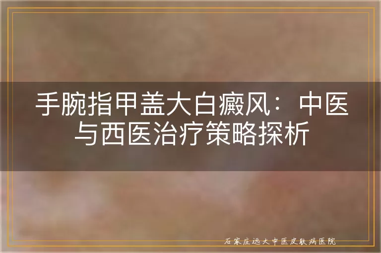 手腕指甲盖大白癜风:中医与西医治疗策略探析