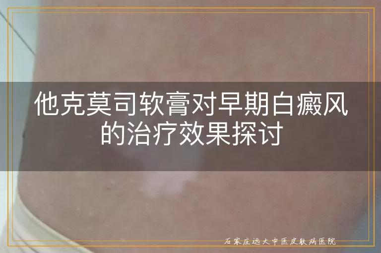 他克莫司软膏对早期白癜风的治疗效果探讨