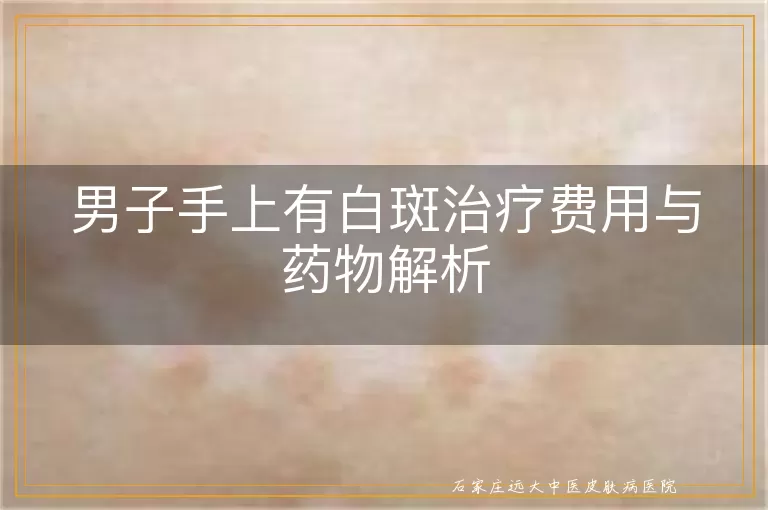 男子手上有白斑治疗费用与药物解析