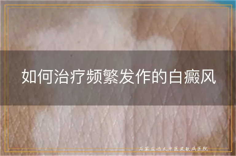 如何治疗频繁发作的白癜风