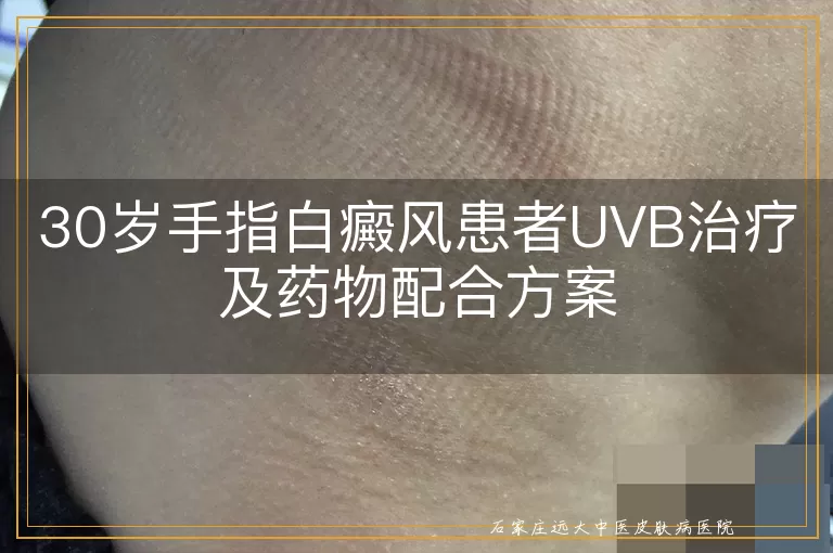 30岁手指白癜风患者UVB治疗及药物配合方案