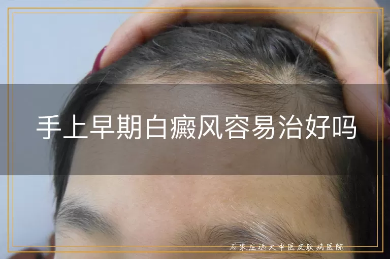 手上早期白癜风容易治好吗