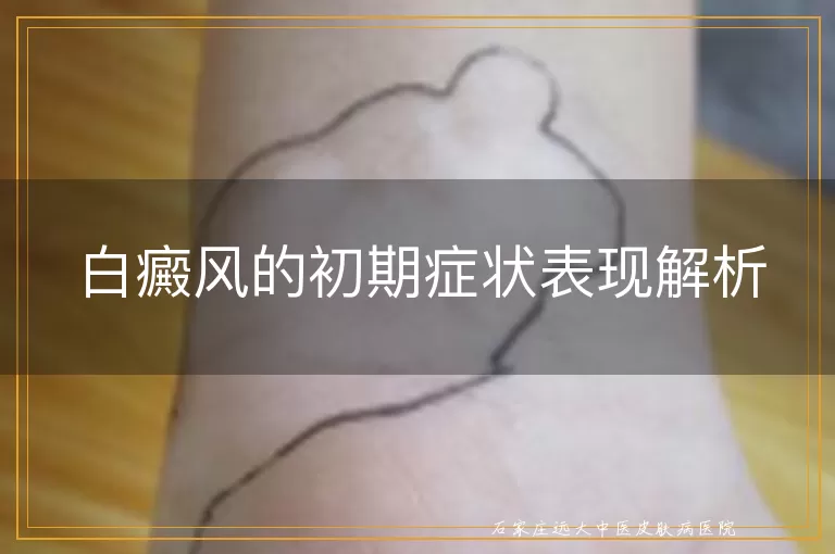 白癜风的初期症状表现解析