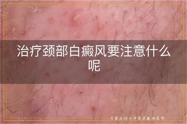治疗颈部白癜风要注意什么呢