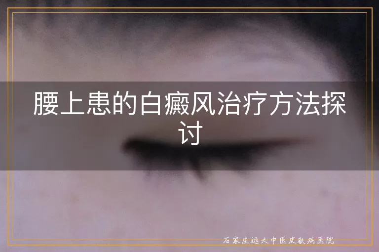 腰上患的白癜风治疗方法探讨