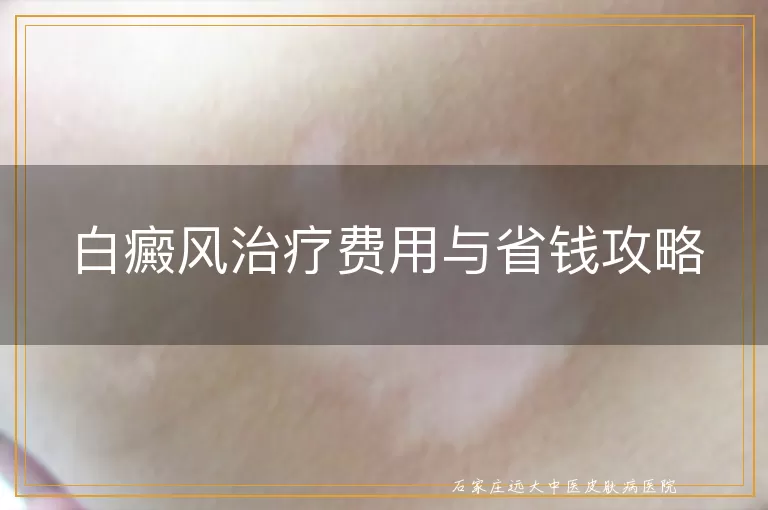 白癜风治疗费用与省钱攻略