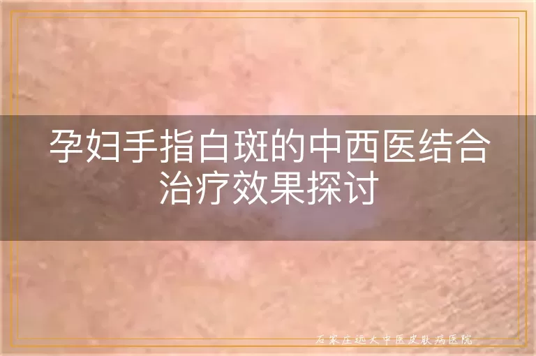 孕妇手指白斑的中西医结合治疗效果探讨