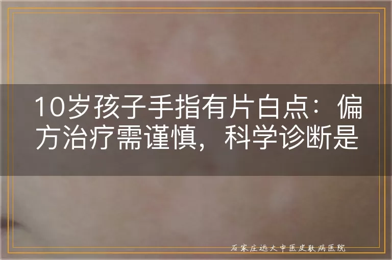 10岁孩子手指有片白点：偏方治疗需谨慎，科学诊断是关键