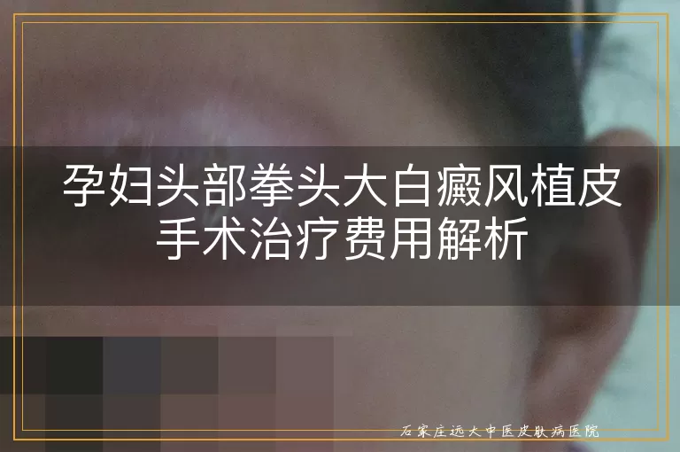 孕妇头部拳头大白癜风植皮手术治疗费用解析