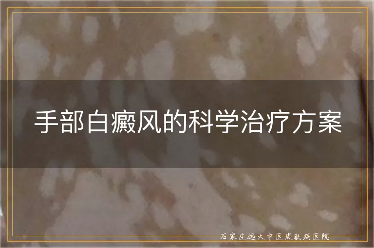 手部白癜风的科学治疗方案
