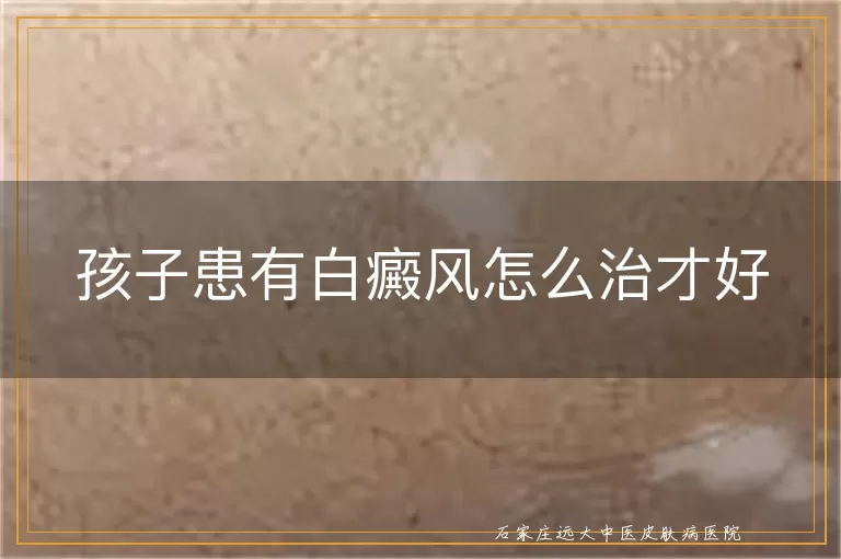 孩子患有白癜风怎么治才好