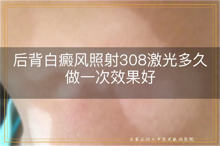 后背白癜风照射308激光多久做一次效果好