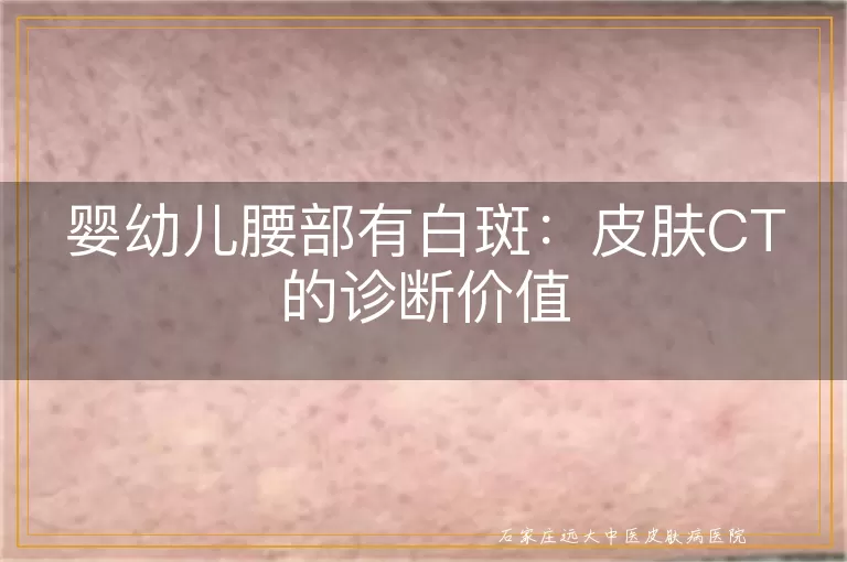 婴幼儿腰部有白斑:皮肤CT的诊断价值