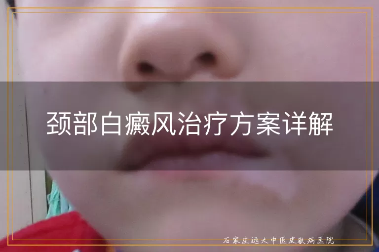 颈部白癜风治疗方案详解