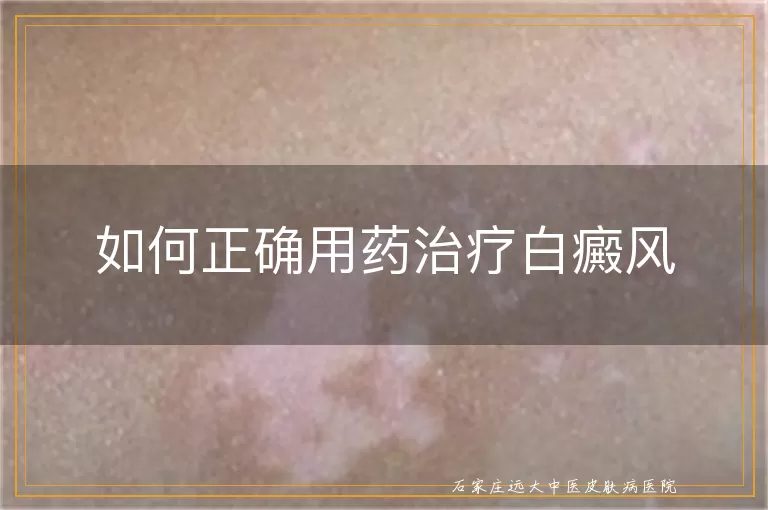 如何正确用药治疗白癜风