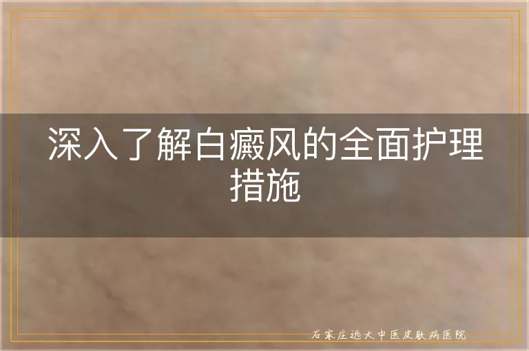 深入了解白癜风的全面护理措施
