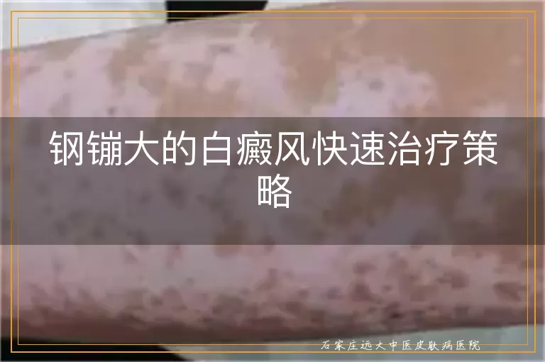 钢镚大的白癜风快速治疗策略