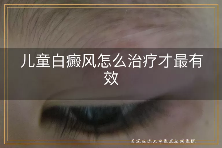 儿童白癜风怎么治疗才最有效