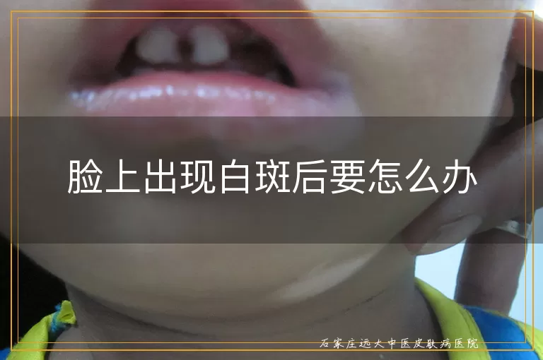 脸上出现白斑后要怎么办