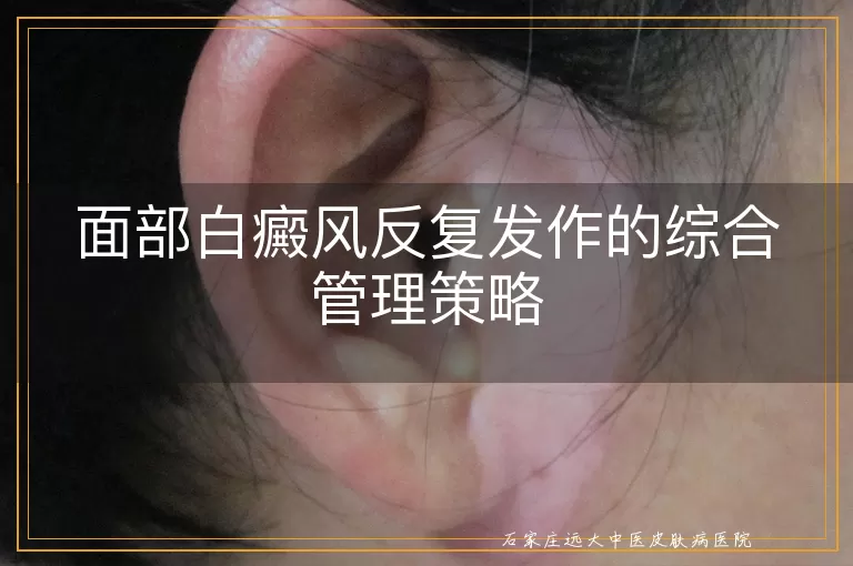 面部白癜风反复发作的综合管理策略