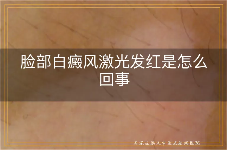 脸部白癜风激光发红是怎么回事