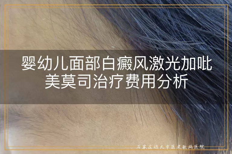 婴幼儿面部白癜风激光加吡美莫司治疗费用分析