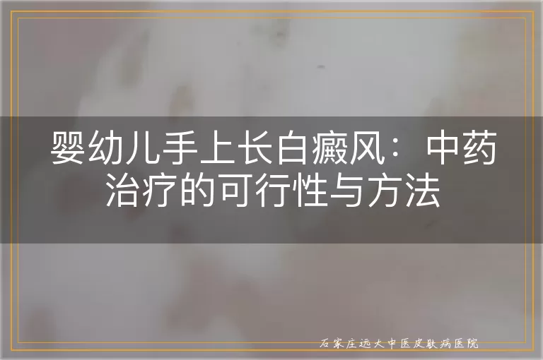 婴幼儿手上长白癜风:中药治疗的可行性与方法