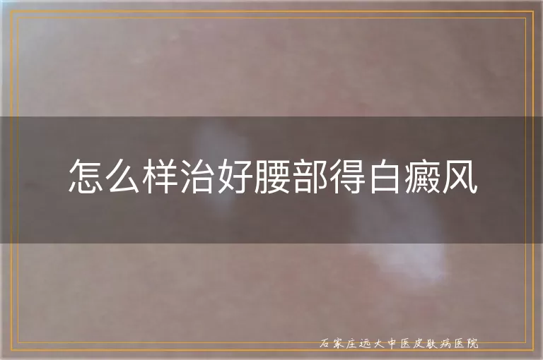 怎么样治好腰部得白癜风