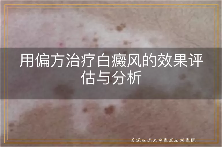用偏方治疗白癜风的效果评估与分析
