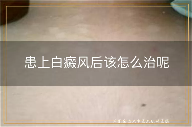 患上白癜风后该怎么治呢