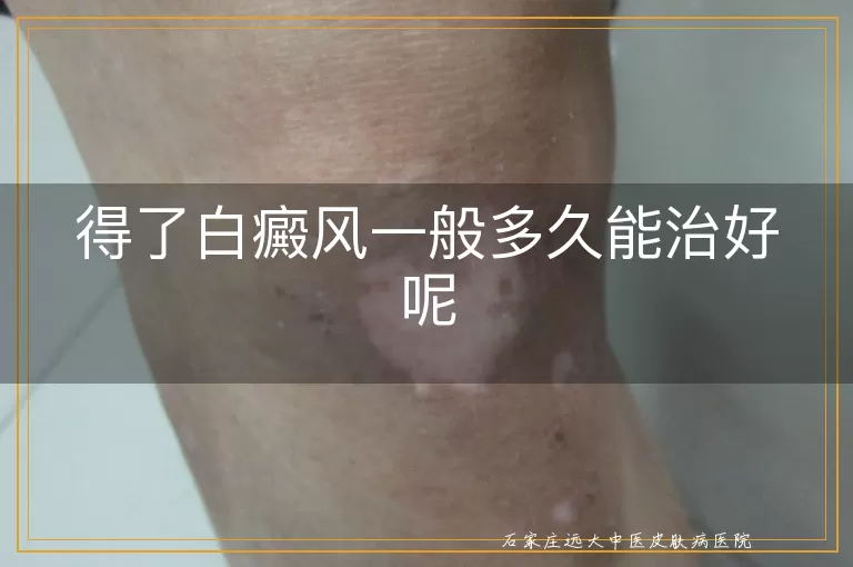 得了白癜风一般多久能治好呢