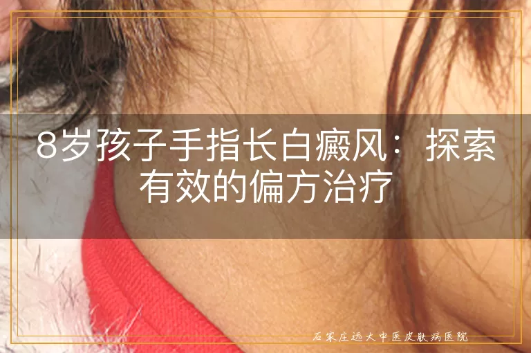 8岁孩子手指长白癜风：探索有效的偏方治疗