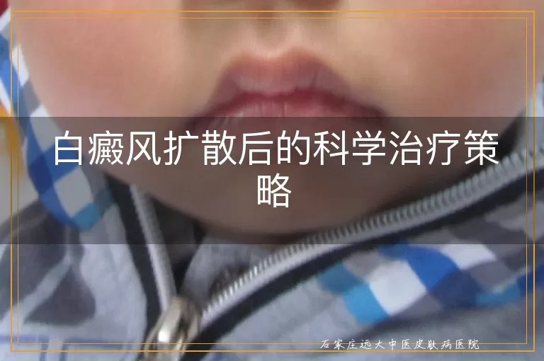 白癜风扩散后的科学治疗策略