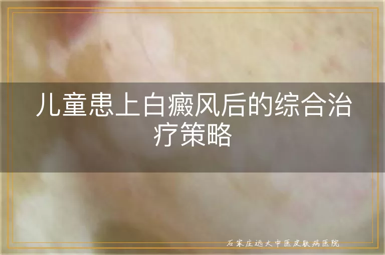 儿童患上白癜风后的综合治疗策略