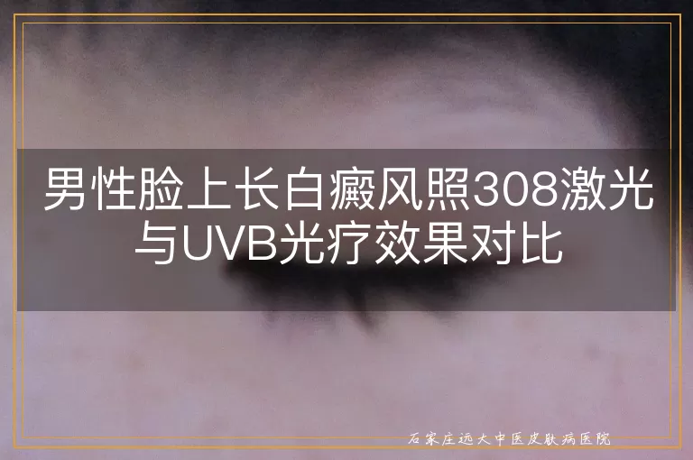 男性脸上长白癜风照308激光与UVB光疗效果对比