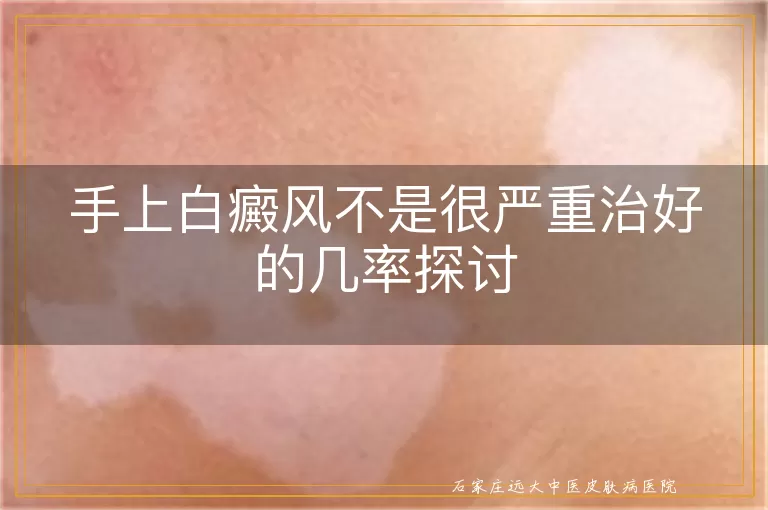 手上白癜风不是很严重治好的几率探讨