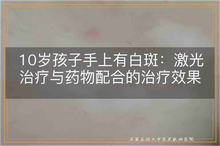 10岁孩子手上有白斑:激光治疗与药物配合的治疗效果探讨