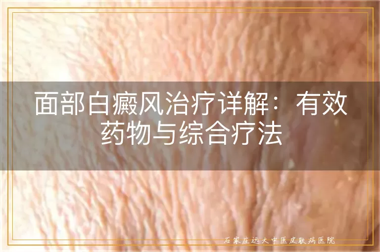 面部白癜风治疗详解:有效药物与综合疗法