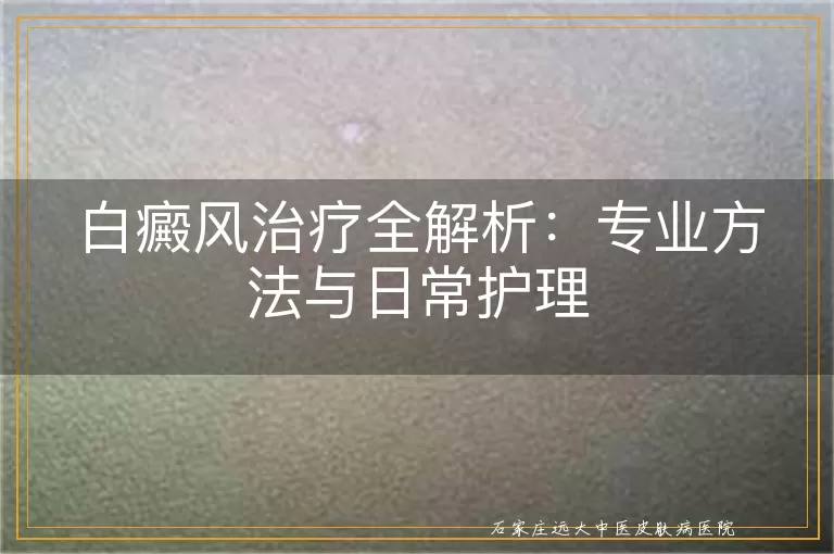 白癜风治疗全解析:专业方法与日常护理
