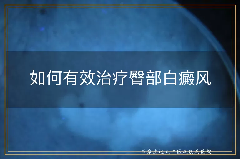 如何有效治疗臀部白癜风