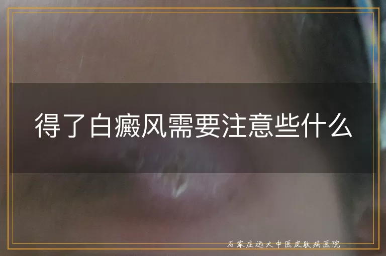 得了白癜风需要注意些什么