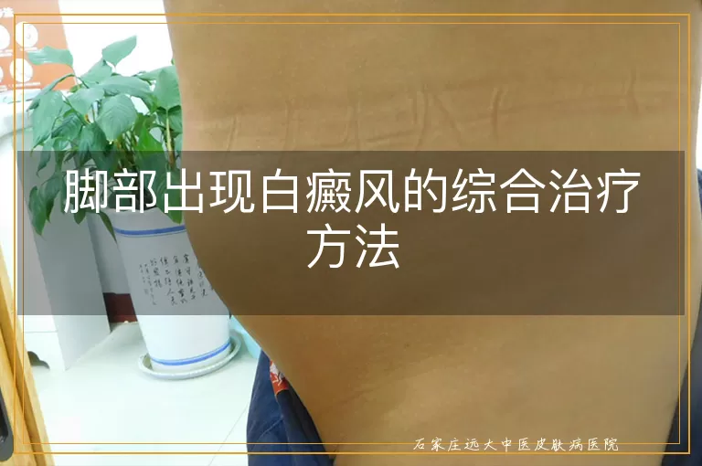 脚部出现白癜风的综合治疗方法